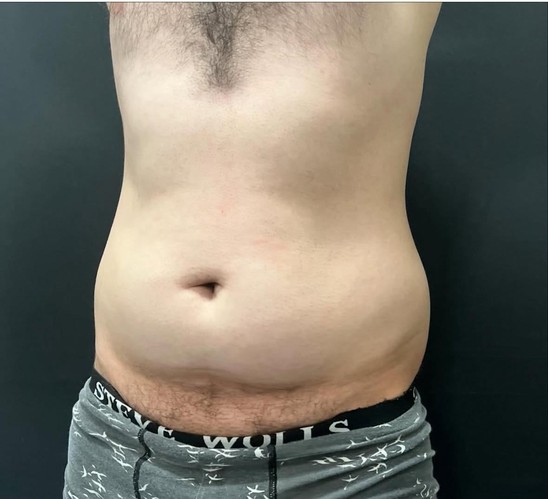 Liposuction360