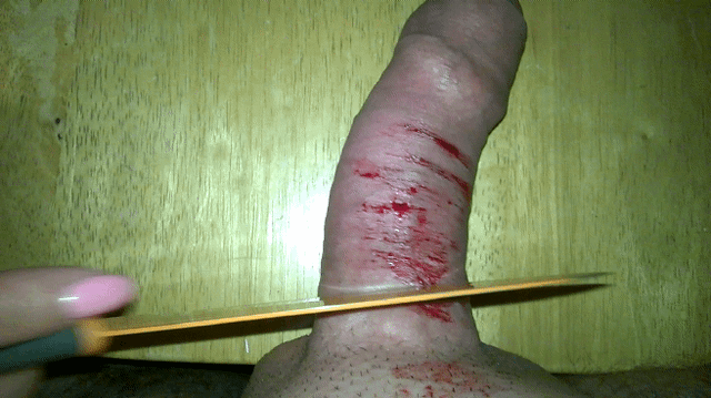 Penectomy_Nullo