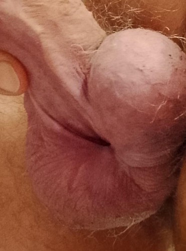 SubincisionMeatotomy